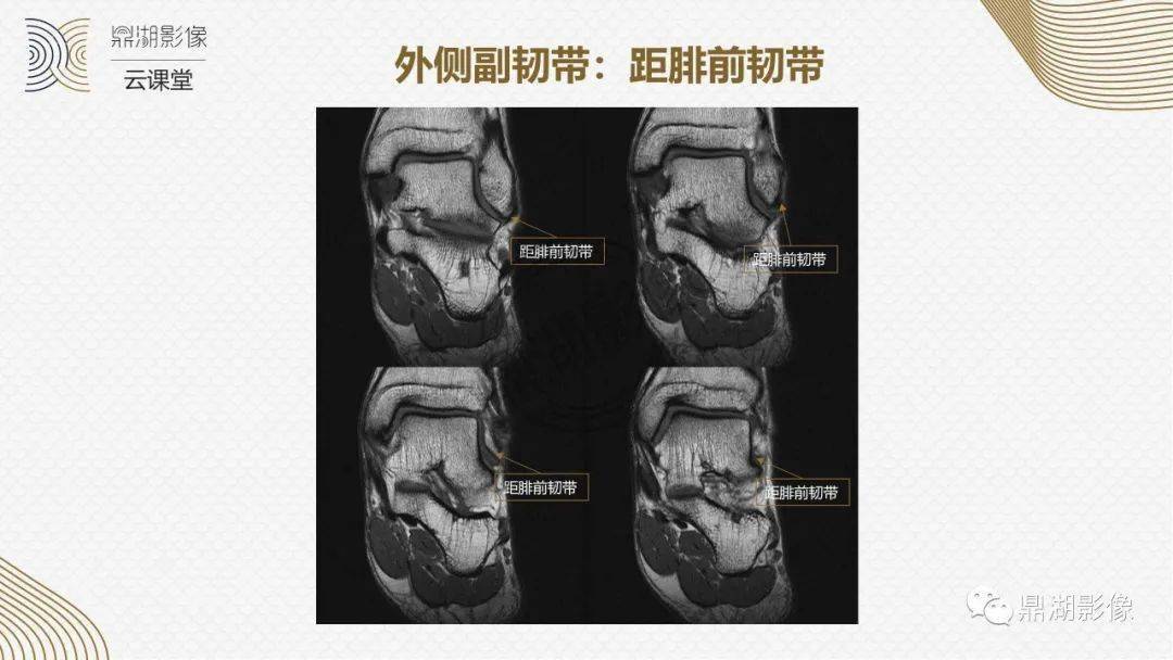 踝关节核磁解剖图图片
