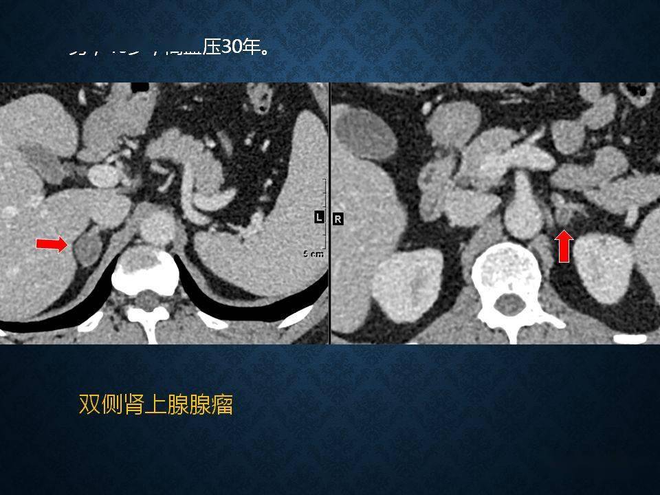 肾上腺丨扫描方案解剖皮质增生及小腺瘤的诊断
