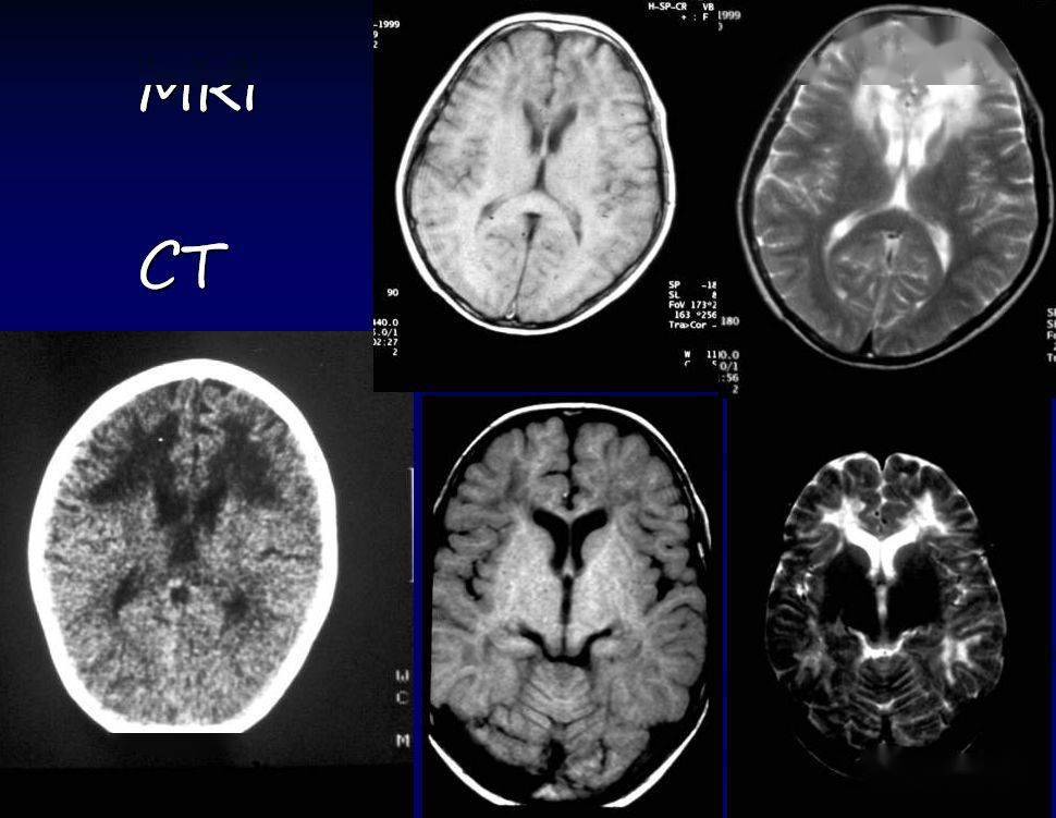 异染性脑白质营养不良ct与mri表现:双侧脑室旁半卵圆区的脑白质内多