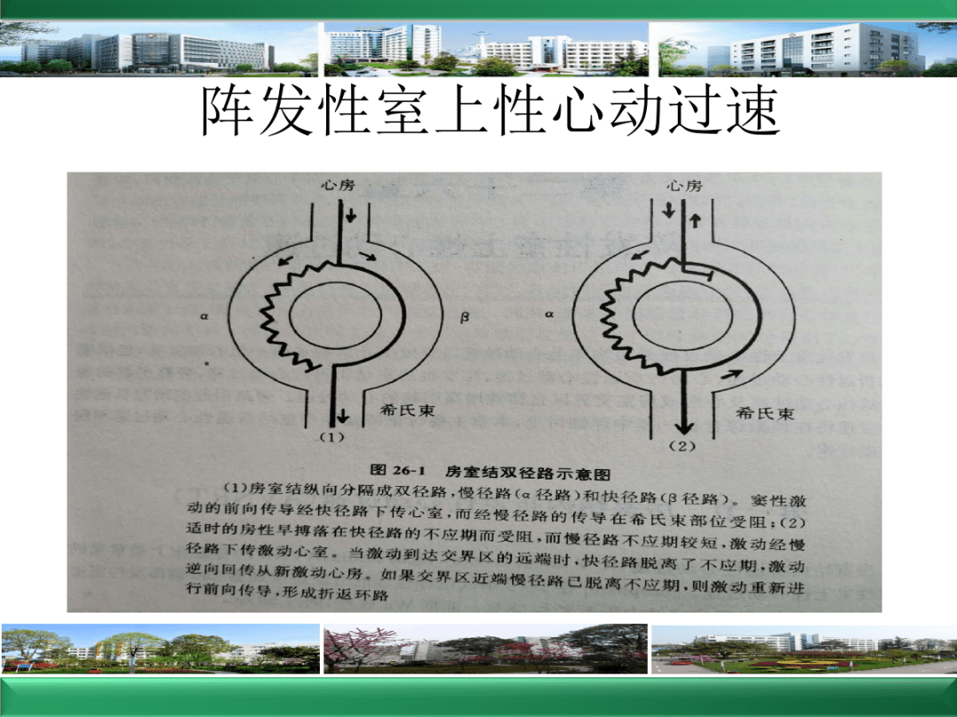 改良瓦氏动作原理图片