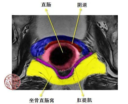 坐骨直肠窝CT图片