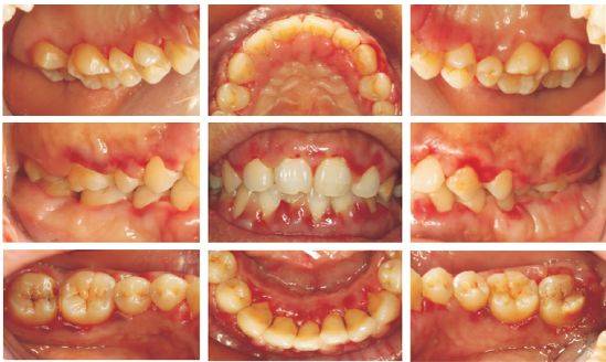 检查:全口牙龈红肿,可见出血点,龈上牙石( )(图1)