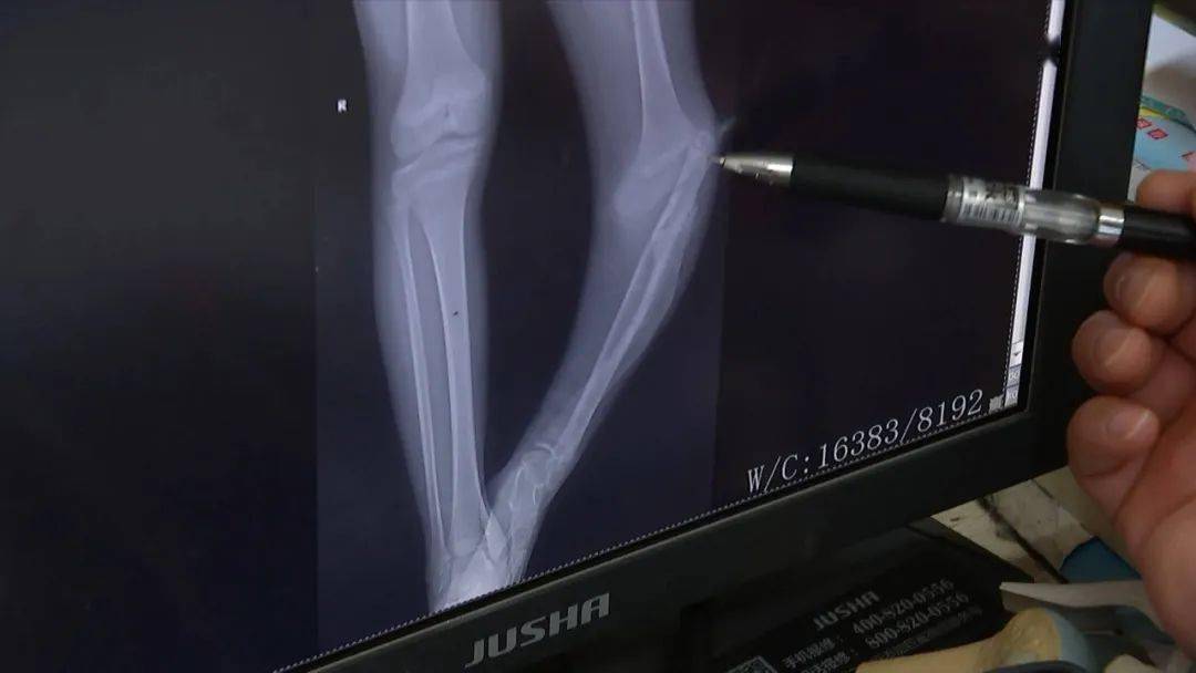 浙江省荣军医院(嘉兴三院)手足外科主任 黄显军:你这个腓骨,现在跑到