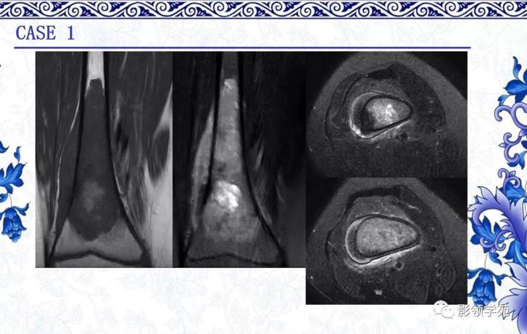 【经典】常见骨源性肿瘤的影像表现