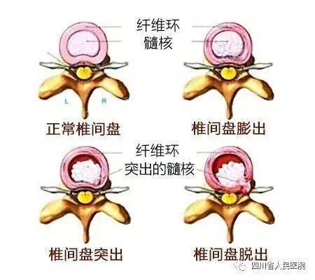 是指經腰椎ct或磁共振(mri)檢查發現椎間盤結構上發生的改變