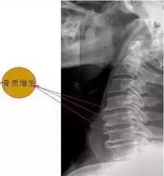 骨刺,是骨质增生的俗称,又称骨赘或骨唇.