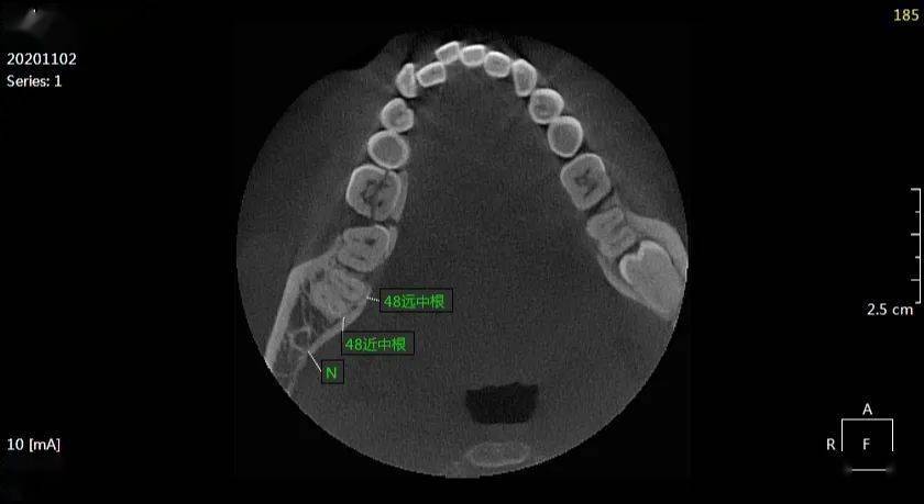 任xx 20201102 智齿cbct 135xxxx8077