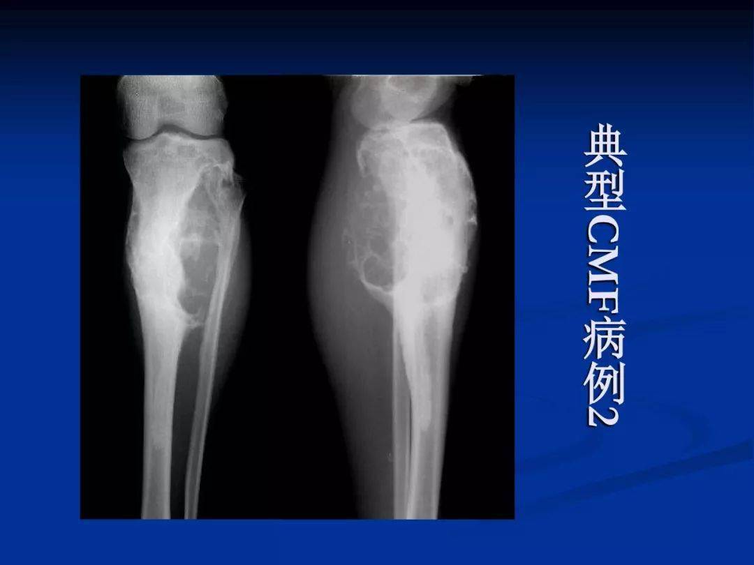 软骨粘液样纤维瘤影像学诊断