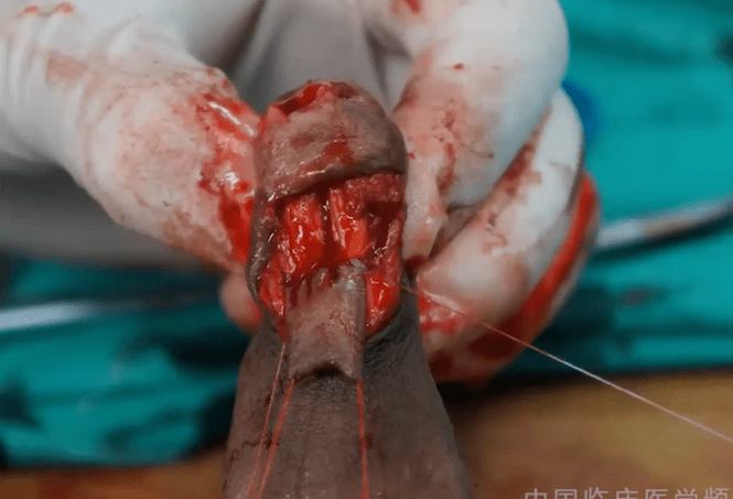尿道口狭窄手术图片图片