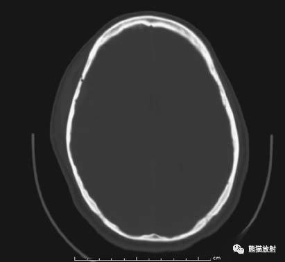 颅脑ct诊断常用的三个窗
