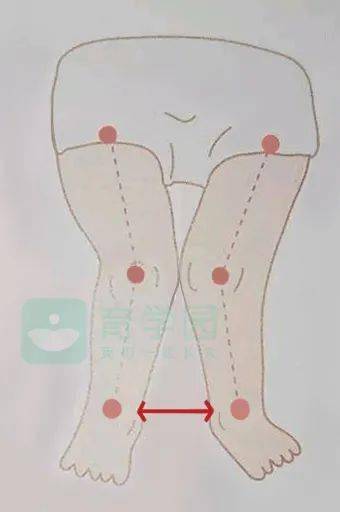 o型腿x型腿和過早站有關如何辨別矯正一篇講明白