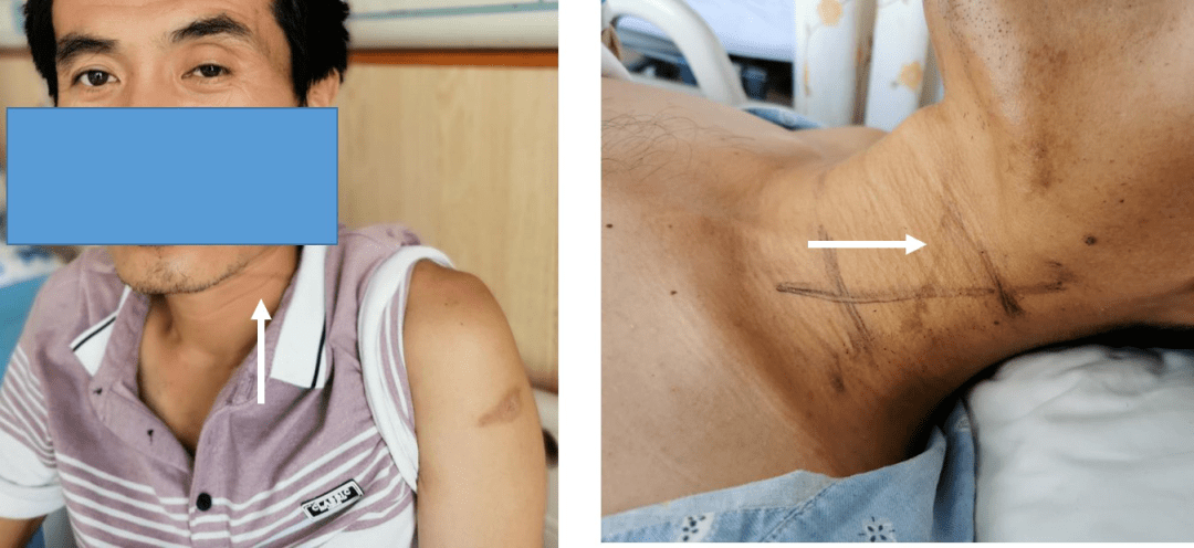 张利勇教授团队丨外伤性颈动脉闭塞一例