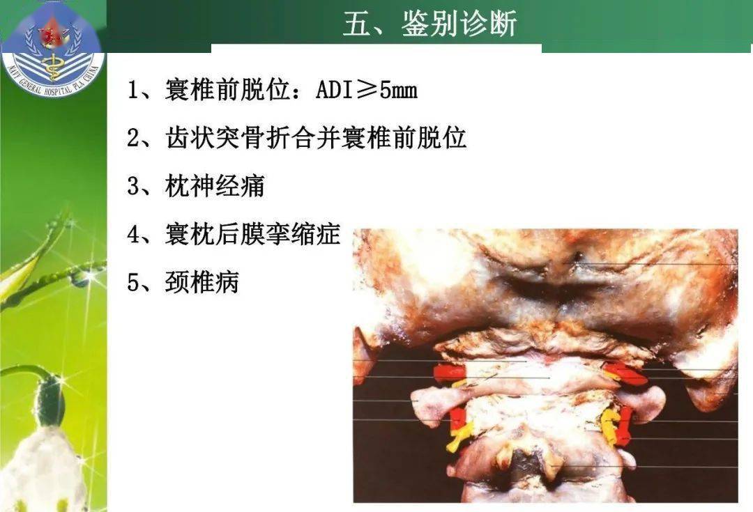 寰樞關節半脫位的針刀及手法治療