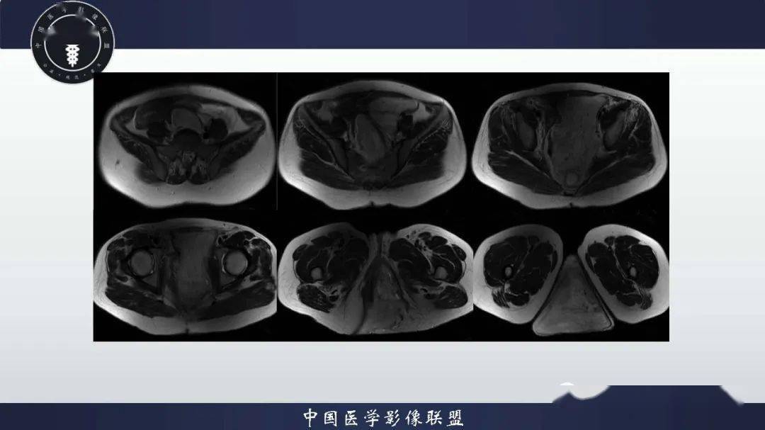 老師提供)相似病例2陰囊內其他病例討論李廣明:支持侵襲性血管粘液瘤