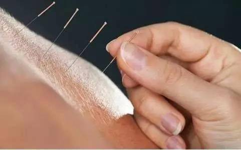 针灸治疗腰痛八法及病案举例