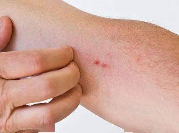 【同齐·科普】尘螨过敏怎么办?