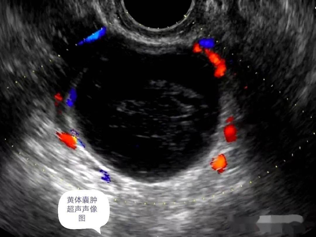 黄体囊肿的超声图片图片