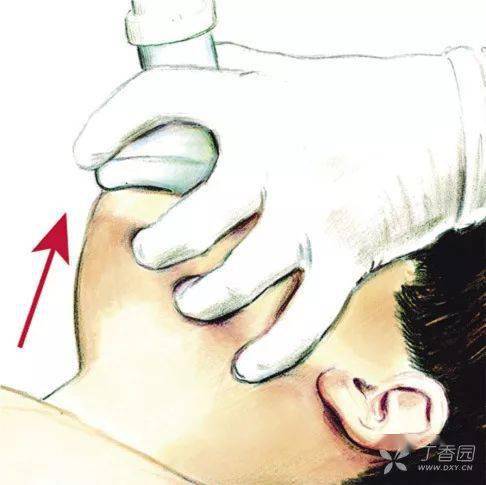 急救必备操作之气管插管