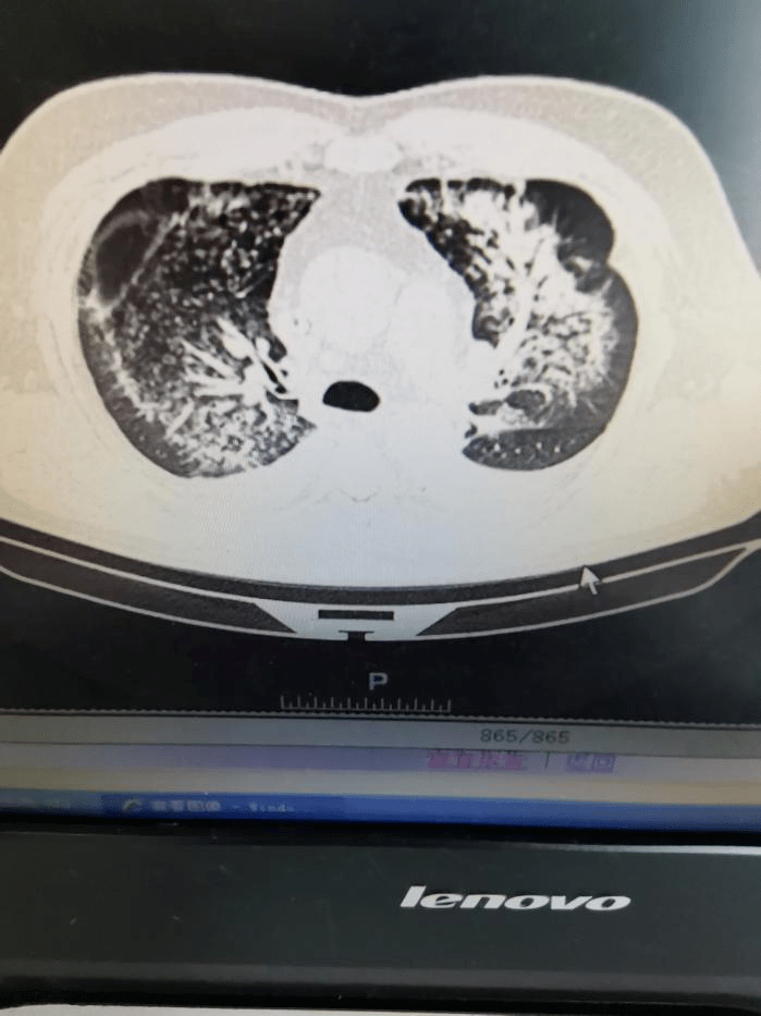 尿毒症肺水肿图片