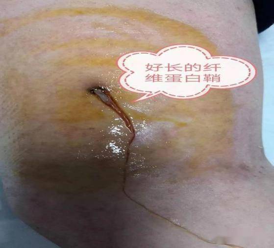 纤维蛋白鞘和血栓形成:纤维蛋白鞘是经过血液中蛋白沉积继发血栓后