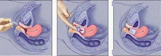 一旦发现白带有血丝,特别是性交后白带混有血丝,应警惕生殖器有恶性