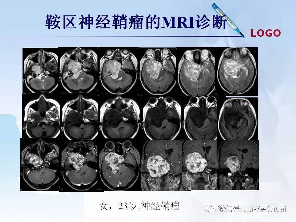 鞍区磁共振图片