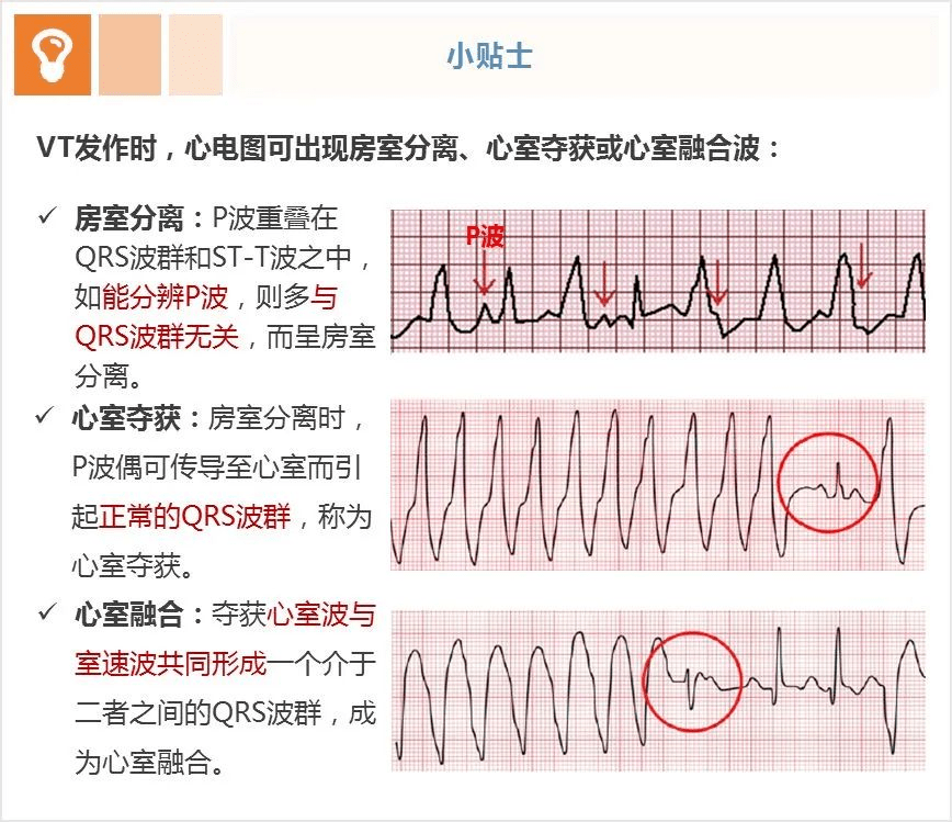 一看就會室速與室上速的快速鑑別方法