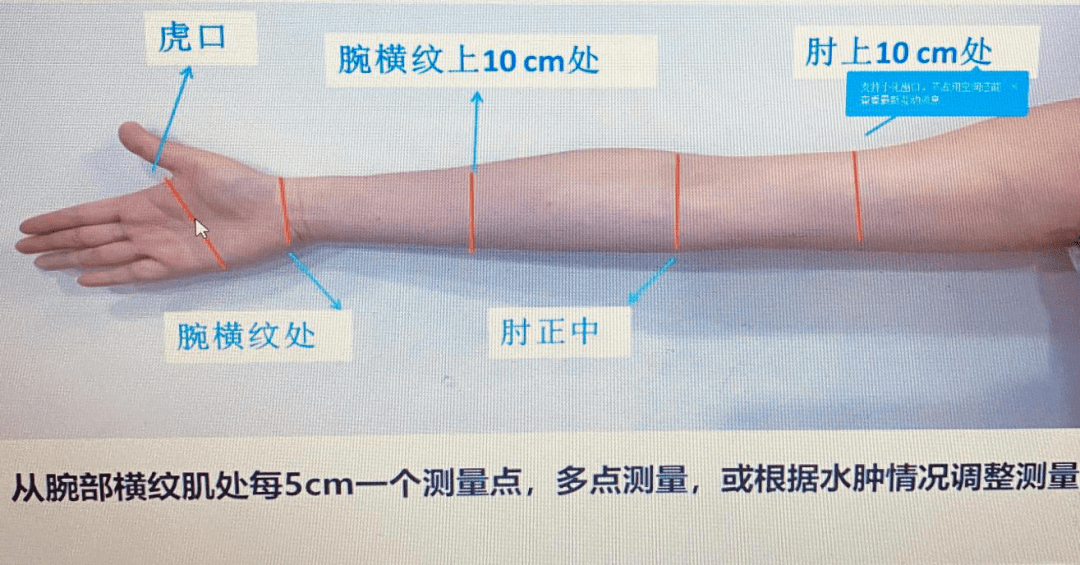 乳腺癌术后要警惕淋巴水肿!