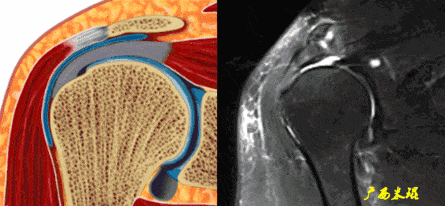 肩关节mri解剖肩袖损伤诊断技巧