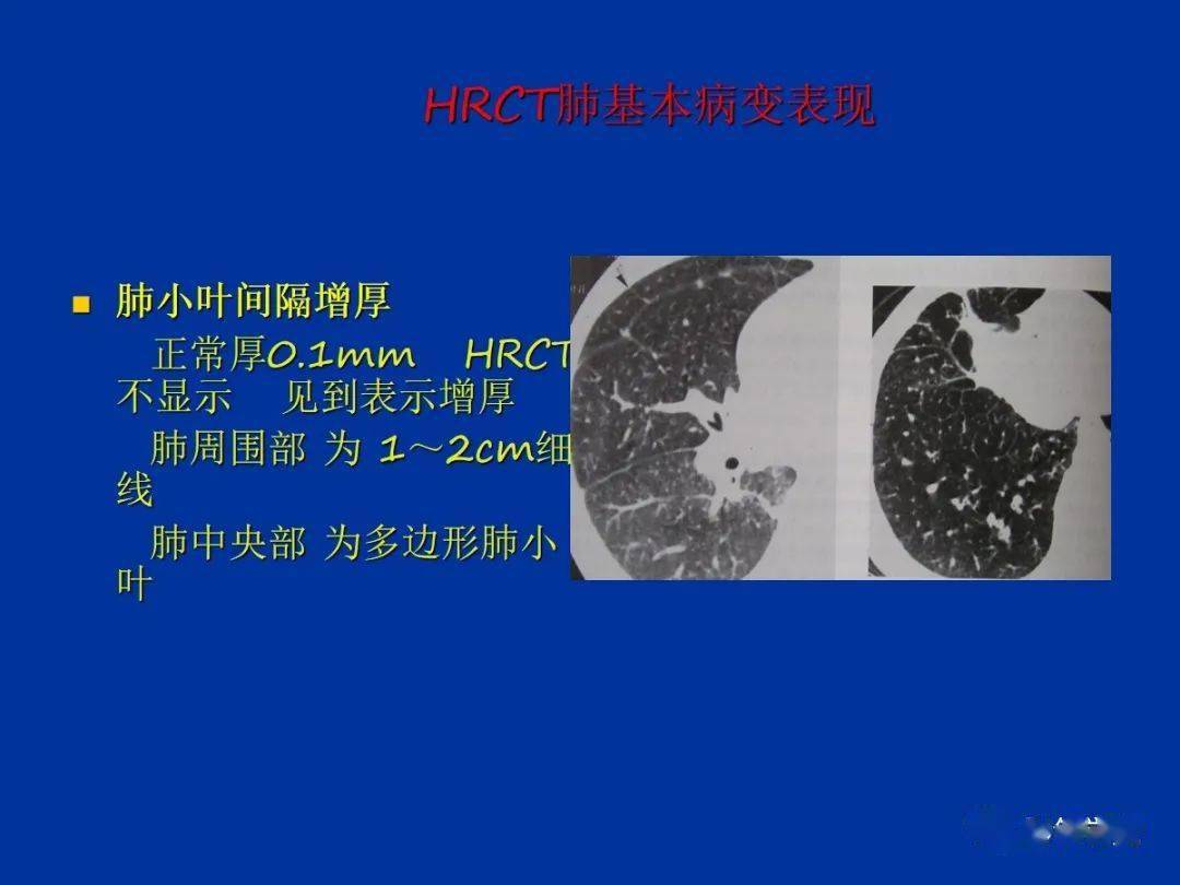 肺小叶,肺间质解剖与病变的hrct诊断