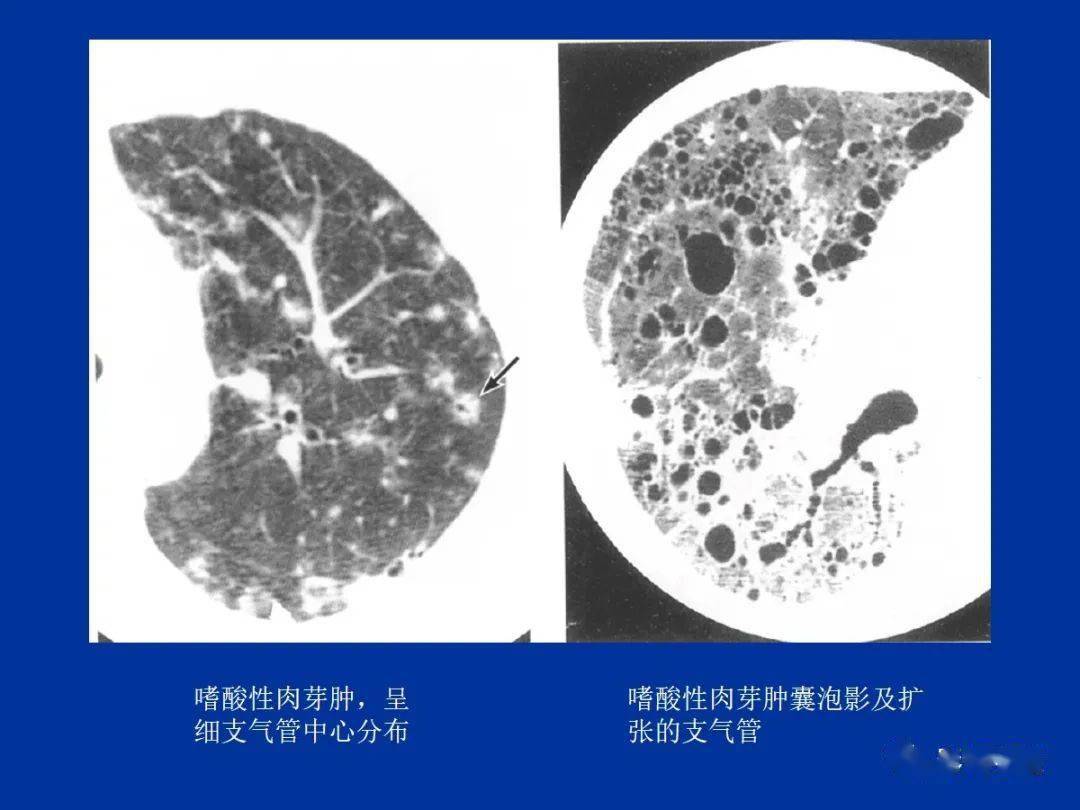 肺小葉,肺間質解剖與病變的hrct診斷