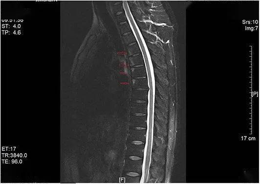 骶髂關節mri平掃:考慮兩側骶髂關節輕度退變.1.胸椎退行性骨關節病.