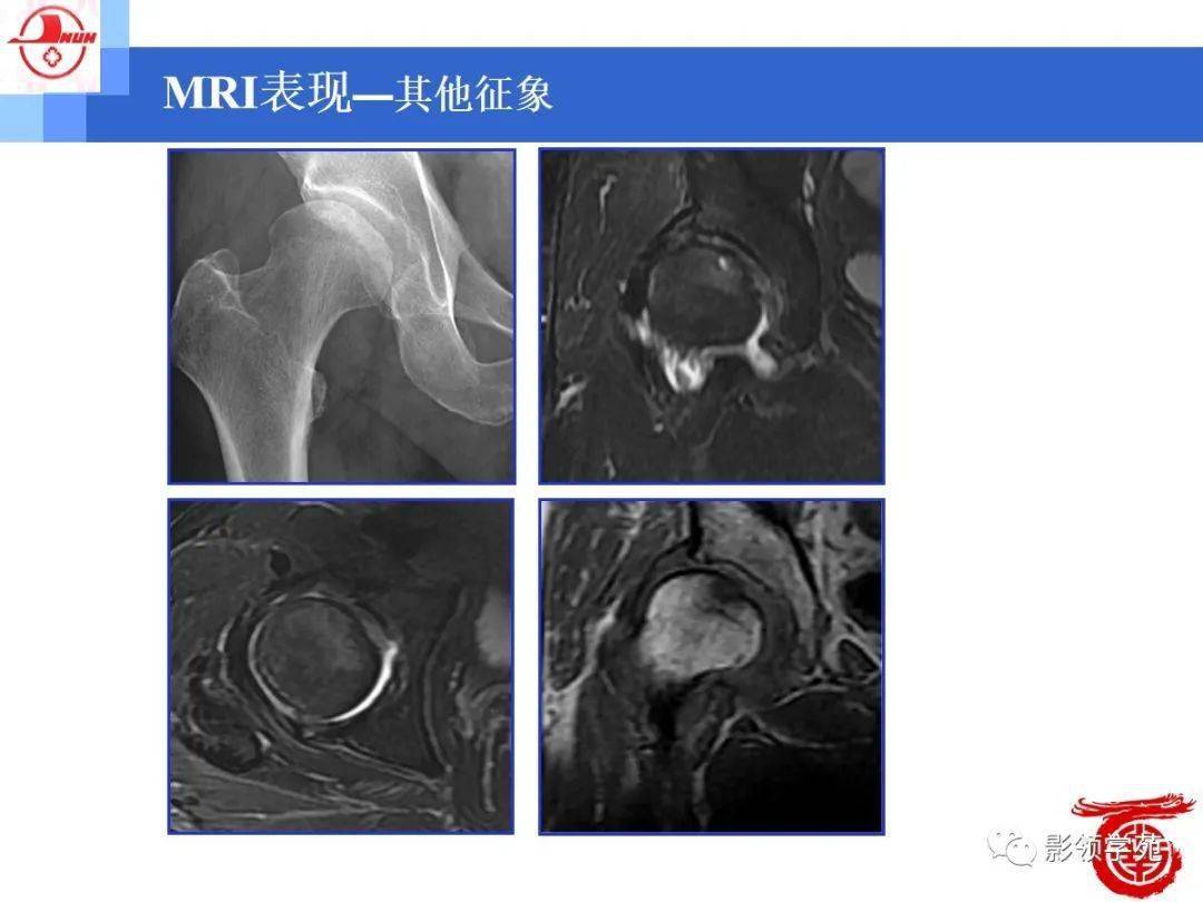 髖臼緣或髖臼唇的異常表現為髖臼緣的增生,硬化;以及髖臼唇形態的