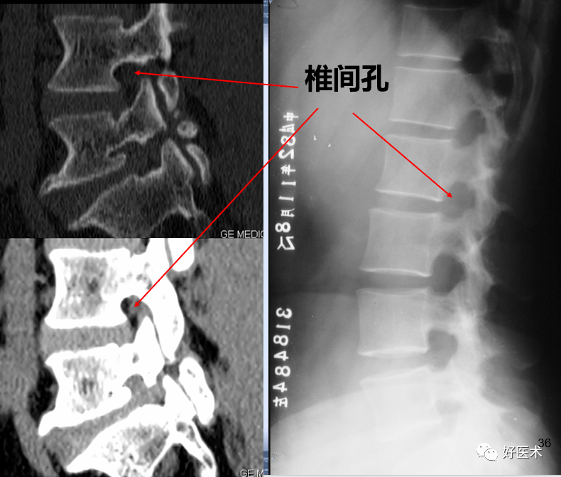 隨著年齡的增長,後緣可變得平直; 正常l5-s1椎間盤的後緣較平直,並可