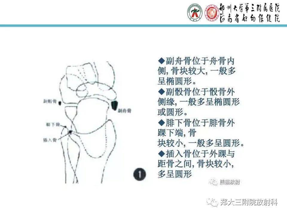 撕脱性骨折示意图图片