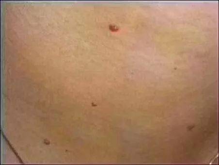 你身上有这样的血痣吗