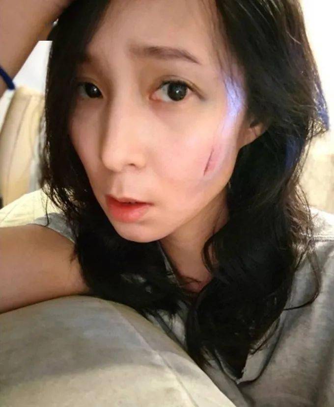 尽管吴嘉仪开了滤镜,但还是能清晰地看到她的伤口