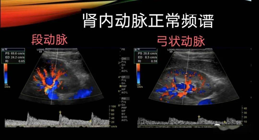 肾动脉解剖位置超声图图片