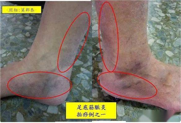 足底筋膜炎处理方法