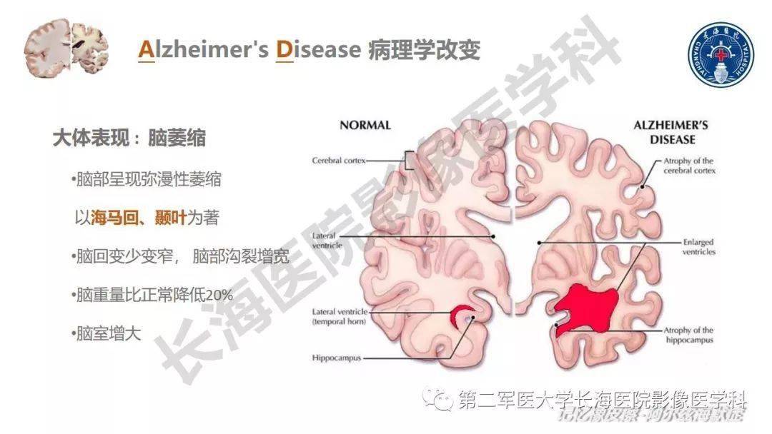 海兹默尔综合症 来自搜狐网