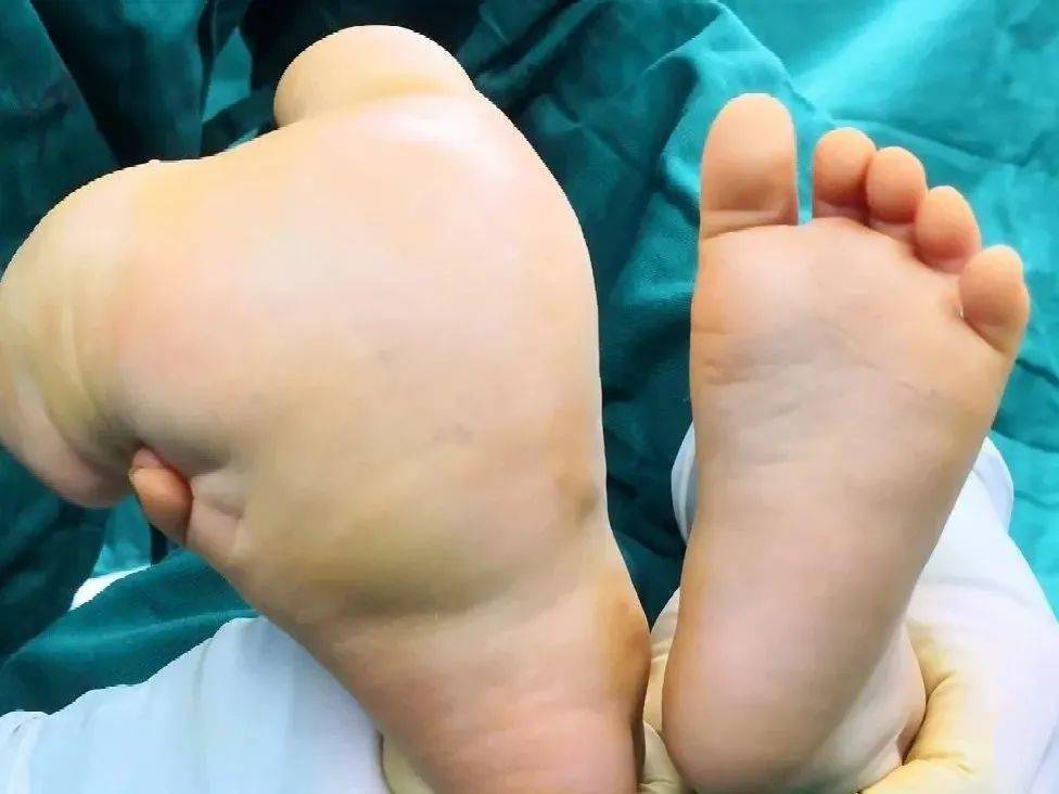 术前术后即刻大体照术前术后即刻x片病例展示二:9岁男孩,先天性双足巨