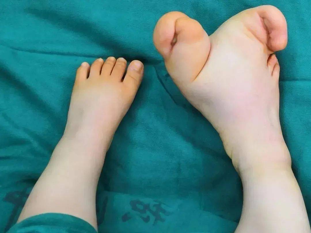 术前术后即刻大体照术前术后即刻x片病例展示二:9岁男孩,先天性双足巨