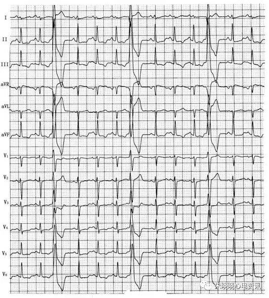 心率加快时出现偶发或频发室性期前收缩,多为单源性,偶见成对单形及