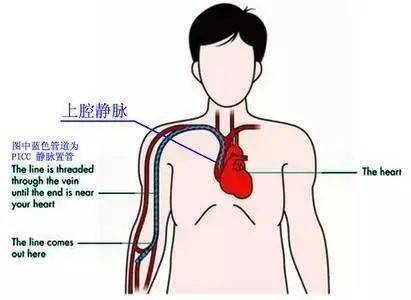 测量cvp只可以使用cvc吗原来还有这么多学问