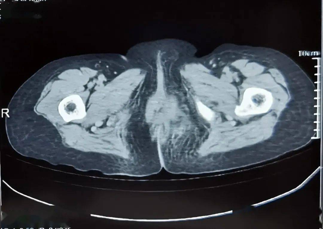 坐骨直肠窝CT图片