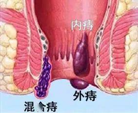 痔瘡指人類肛門裡,外長的小肉球,是肛周常見疾病,主要分為內痔,外痔