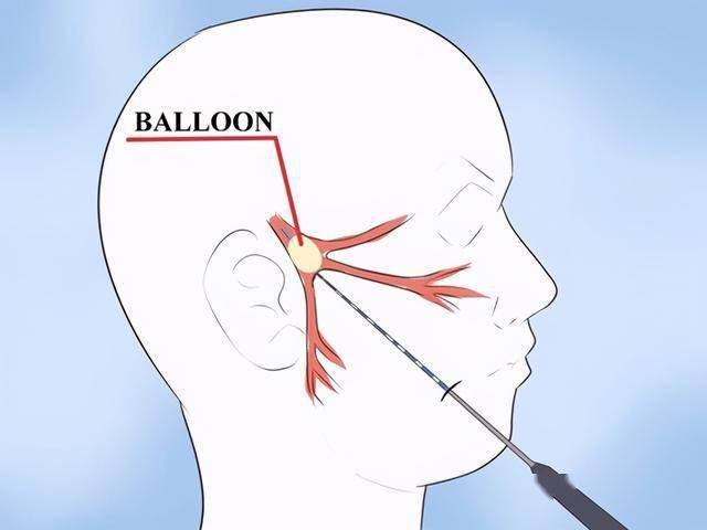 pbc(percutaneous micro-ballon compression pbc的)原理在於球囊壓迫