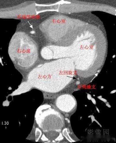 影像解剖 | 心脏冠状动脉ct解剖中文详细标注(图文)