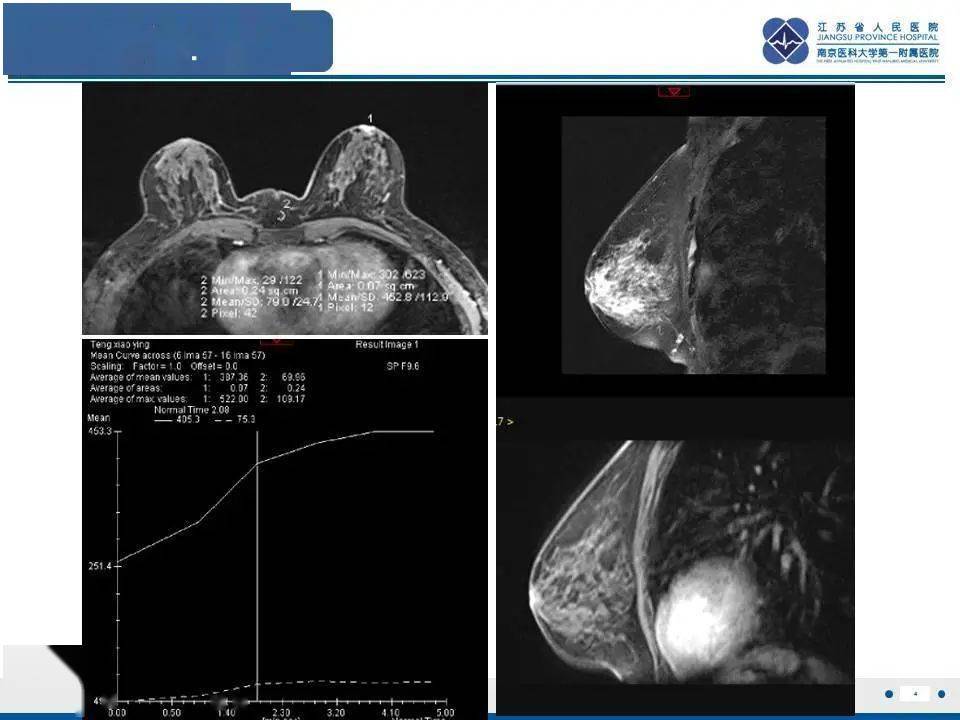 每日一例1205乳腺paget病病例精读分析