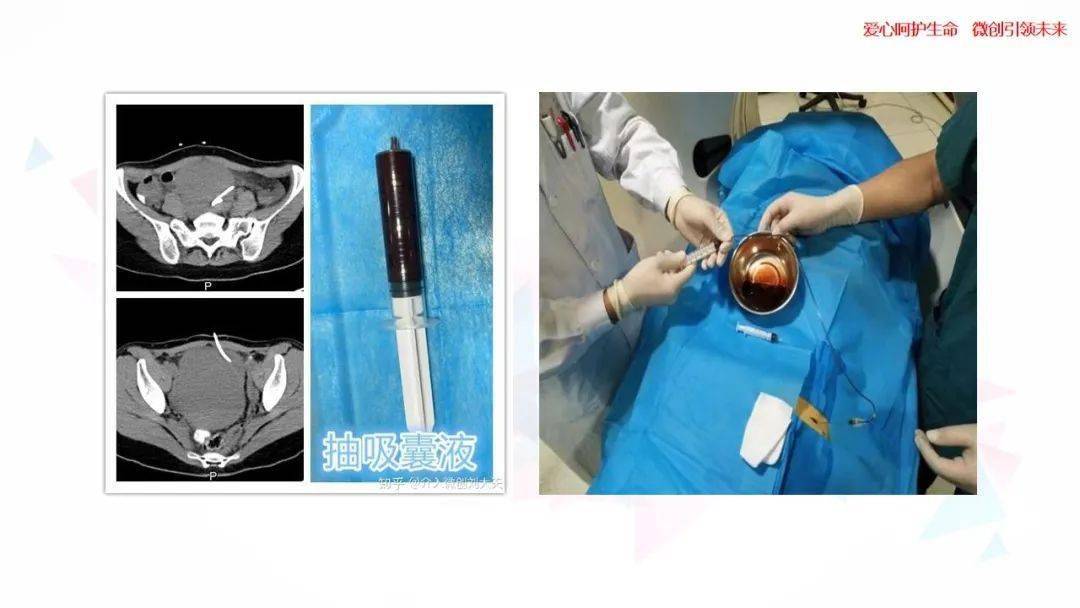 卵巢巧克力囊肿手术图片